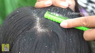 Satisfying Extremely Damaged Dandruff Scratching 1922 [upl. by Ijok97]