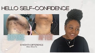 Electrolysis Changed My Life  Best Solution for Hirsutism Ingrown Hairs and PCOS [upl. by Dilisio]