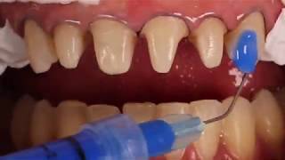 Adhesive cementation of ceramic veneers [upl. by Imiaj205]