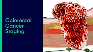 Colorectal Cancer Staging [upl. by Rocco]