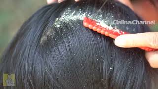 Satisfying Extremely Damaged Dandruff Scratching 2129 [upl. by Lime962]