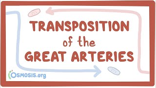 Transposition of the great arteries TGA  causes symptoms treatment amp pathology [upl. by Terrance]