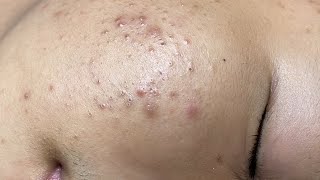 ACNE TREATMENT VU QUYNH MI  Perennial Blackheads On Boy Face 2024FULL [upl. by Lleirbag]