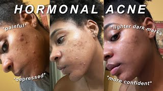 MY HORMONAL ACNE JOURNEY  Skincare Products Spironolactone  More [upl. by Magas336]