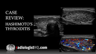 Ultrasound of Hashimoto’s Thyroiditis [upl. by Assilana]