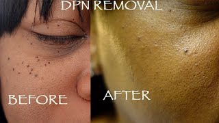 DPN Removal  Dermatosis Papulosa Nigra [upl. by Limann970]