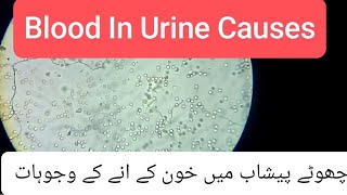 Causes of Blood in Urine  Hematuria  Calcium Oxalate in Urine [upl. by Kalfas957]