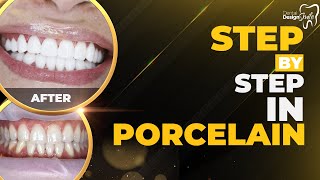 Have you seen how porcelain veneers are installed [upl. by Ennahs]