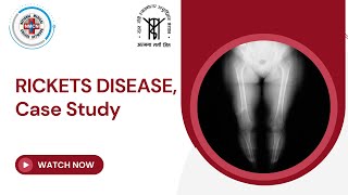 RICKETS DISEASE Case Study [upl. by Nosral]