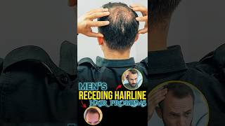 Hair Loss Receding Hairline Treatment [upl. by Ysor]