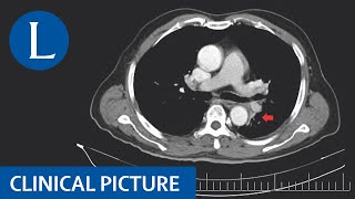 Diagnosing a mediastinal mass [upl. by Lamarre]