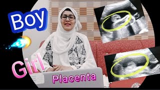 QAs  Anterior Placenta means baby Girl  Posterior Placenta means baby GirlBoy  Fundal Placenta [upl. by Anaili552]