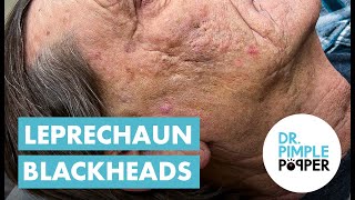 Blackhead Blackheads amp Blackheads Extended Leprechaun Blackheads [upl. by Rabiah]