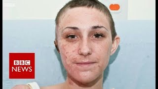 Inside the hospital treating acid attack scars  BBC News [upl. by Peadar184]