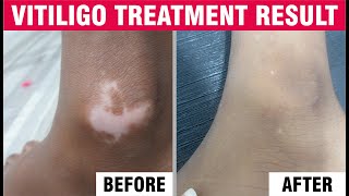 Best Vitiligo treatments  Vitiligo treatments specialist  Sakhiya Skin Clinic Review [upl. by Artapoelc]