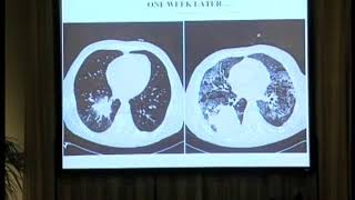 Why is invasive aspergillosis such a difficult disease to diagnose and treat [upl. by Schaaff]