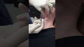 KYBELLA® Treatment  Dr Steven H Turkeltaub  Plastic Surgeon in Scottsdale AZ [upl. by Manolo134]