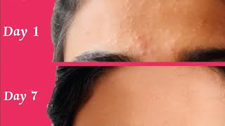 Neem patta se pimple face pack home tutorial use 7 day see result [upl. by Tshombe]