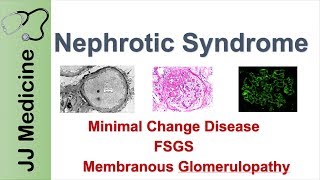 Nephrotic Syndrome  Clinical Presentation Causes and Treatment [upl. by Zacks721]