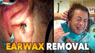 MASSIVE EARWAX REMOVAL  Dr Paul feat Maiya [upl. by Gervase917]