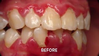 Treatment of Periodontal Gum Disease [upl. by Nepean]