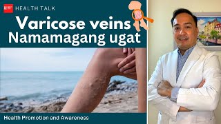 Namamagang ugat Varicose veins [upl. by Aidekal]