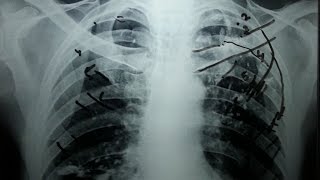 How to count Ribs on Chest X Ray In 5 minutes [upl. by Ailedroc]