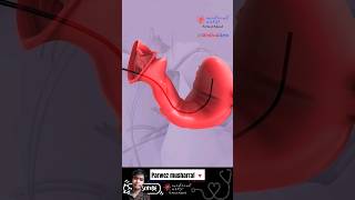 Brachytherapy cervical cancer shorts knowledge animation [upl. by Eckmann]