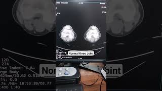 CT SCAN OF KNEE JOINTshorts viral [upl. by Roon]