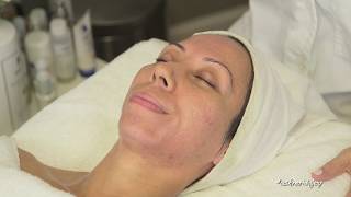 Skin Prepped amp Deep Scarring Peel [upl. by Sachi]