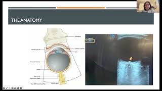 Neurocritical Care amp Pearls Noninvasive Monitoring of Intracranial Pressure Alexandra Reynolds MD [upl. by Ydoc]