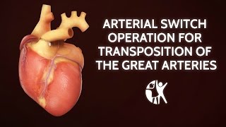 Arterial Switch Operation for Transposition of the Great Arteries  Cincinnati Childrens [upl. by Oniluap]