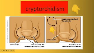 Cryptorchidism [upl. by Airehtfele]