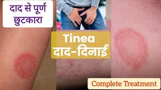 Tinea Cruris  Ringworm  दाद दिनाई का complete Treatment tinea ringworm jockitch Daad ka ilaj [upl. by Sybilla]