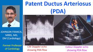 Patent Ductus Arteriosus PDA [upl. by Eras]