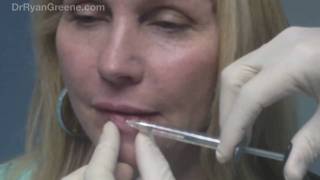 Lip Augmentation with Juvederm Injection  Fort Lauderdale [upl. by Anem869]