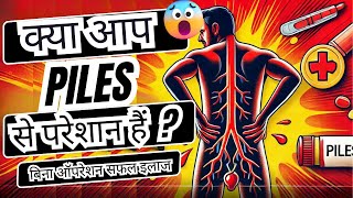 बिना ऑपरेशन PILES का स्थायी इलाज🔥– घर बैठे Online इलाज 🔥pdmhomeopathy piles education pdmjaipur [upl. by Swithbart]