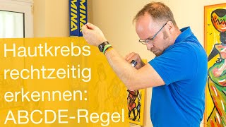 Hautkrebs rechtzeitig erkennen ✅ ABCDERegel [upl. by Neeroc926]