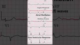 Hypothermia ECG Rhythm abnormalities [upl. by Hazeghi]