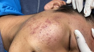 ACNE TREATMENT VU QUYNH MI Acne On Teens Cheek 2024 [upl. by Nate]