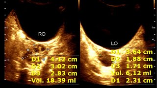 Two Cases of Polycystic ovarian Cyst Disease  Sonographic Prediction [upl. by Arammat]