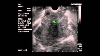 Diagnosis of Thymoma by EUS FNA  Bronte Holt [upl. by Sergu]