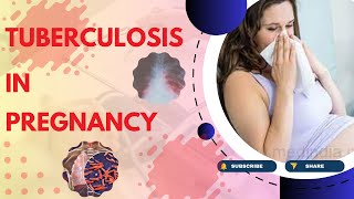 Tuberculosis in Pregnancy Causes Symptoms Diagnosis Treatment and Pathology  TOG Article [upl. by Alleroif280]