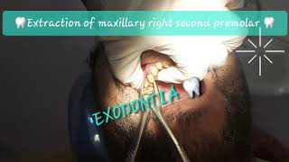 Buccal to lingual motion maxillary 2nd premolar extraction with double curvatures Sshaped roots [upl. by Rainwater]