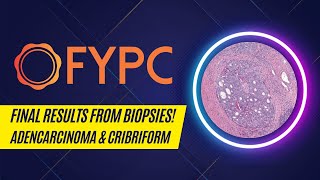 Prostate Cancer  Biopsy Results  What Do They Mean [upl. by Nyad]