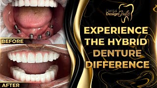 Experience the Hybrid Denture Difference [upl. by Salomi119]