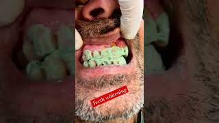 Teeth whitening 🦷🦷🪥👍 orthodonticbraces dentistnearby teethwhitening 🦷🙏 [upl. by Weismann67]