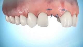 2fase implantaatbehandeling [upl. by Hendren]