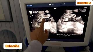 posterior placenta and baby boyBaby boy on ultrasound Radiology by DrRimsha [upl. by Paviour]