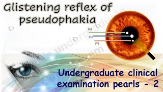 Glistening reflex in pseudophakia Undergraduate Clinical Examination Pearls 2 [upl. by Elleinnad832]